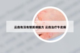 云南有沒(méi)有銀屑病偏方 云南治療牛皮癬
