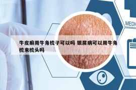 牛皮癬用牛角梳子可以嗎 銀屑病可以用牛角梳來梳頭嗎