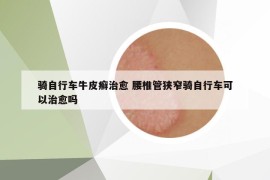 騎自行車牛皮癬治愈 腰椎管狹窄騎自行車可以治愈嗎
