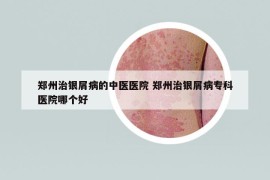鄭州治銀屑病的中醫(yī)醫(yī)院 鄭州治銀屑病?？漆t(yī)院哪個(gè)好