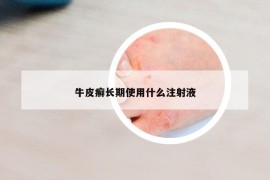 牛皮癬長期使用什么注射液