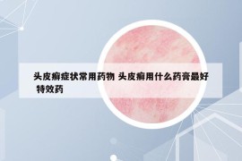 頭皮癬癥狀常用藥物 頭皮癬用什么藥膏最好 特效藥