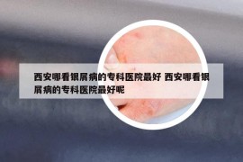 西安哪看銀屑病的專科醫(yī)院最好 西安哪看銀屑病的?？漆t(yī)院最好呢