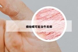 癩蛤蟆可能治牛皮癬