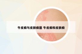 牛皮癬與皮膚癬菌 牛皮癬和皮膚癬
