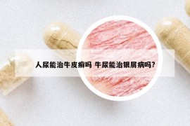 人尿能治牛皮癬嗎 牛尿能治銀屑病嗎?