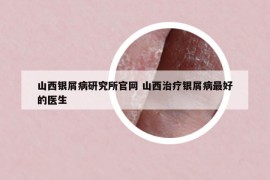 山西銀屑病研究所官網(wǎng) 山西治療銀屑病最好的醫(yī)生