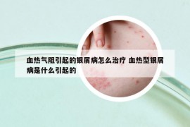 血熱氣阻引起的銀屑病怎么治療 血熱型銀屑病是什么引起的