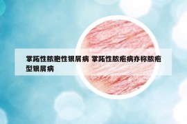 掌跖性膿胞性銀屑病 掌跖性膿皰病亦稱膿皰型銀屑病