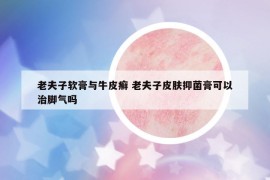 老夫子軟膏與牛皮癬 老夫子皮膚抑菌膏可以治腳氣嗎
