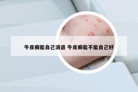 牛皮癬能自己消退 牛皮癬能不能自己好