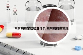 銀屑病血常規(guī)檢查什么 銀屑病的血常規(guī)
