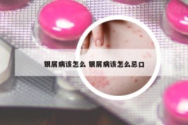 銀屑病該怎么 銀屑病該怎么忌口
