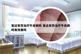 復(fù)達(dá)安蘇治療牛皮癬嗎 復(fù)達(dá)安蘇治療牛皮癬嗎有效果嗎