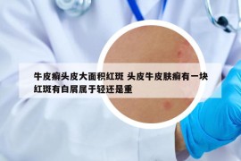 牛皮癬頭皮大面積紅斑 頭皮牛皮膚癬有一塊紅斑有白屑屬于輕還是重