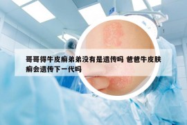 哥哥得牛皮癬弟弟沒有是遺傳嗎 爸爸牛皮膚癬會遺傳下一代嗎