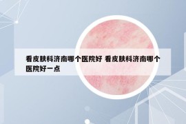 看皮膚科濟南哪個醫(yī)院好 看皮膚科濟南哪個醫(yī)院好一點