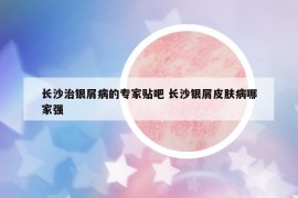 長沙治銀屑病的專家貼吧 長沙銀屑皮膚病哪家強