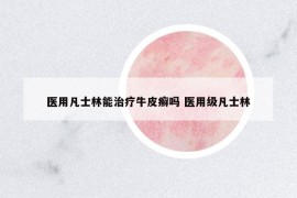 醫(yī)用凡士林能治療牛皮癬嗎 醫(yī)用級凡士林