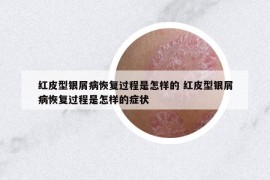 紅皮型銀屑病恢復(fù)過(guò)程是怎樣的 紅皮型銀屑病恢復(fù)過(guò)程是怎樣的癥狀