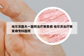 哈爾濱醫(yī)大一醫(yī)院治療銀屑病 哈爾濱治療銀屑病專科醫(yī)院