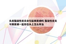 頭皮脂溢性皮炎會(huì)引起銀屑病嗎 脂溢性皮炎與銀屑病一起存在頭上怎么樣治