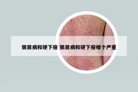 銀屑病和硬下疳 銀屑病和硬下疳哪個嚴重