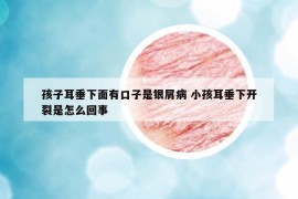 孩子耳垂下面有口子是銀屑病 小孩耳垂下開裂是怎么回事