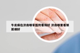 牛皮癬在濟(jì)南哪家醫(yī)院看得好 濟(jì)南哪里看銀屑病好