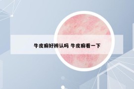 牛皮癬好辨認(rèn)嗎 牛皮癬看一下