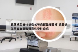 銀屑病型脊柱病性關(guān)節(jié)炎都是哪里疼 銀屑病關(guān)節(jié)炎會(huì)導(dǎo)致強(qiáng)直性脊柱炎嗎