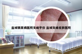 鹽城銀屑病醫(yī)院文峰平價(jià) 鹽城文峰皮膚醫(yī)院