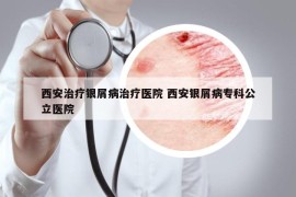 西安治療銀屑病治療醫(yī)院 西安銀屑病?？乒⑨t(yī)院