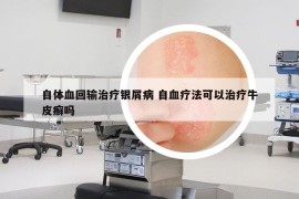 自體血回輸治療銀屑病 自血療法可以治療牛皮癬嗎
