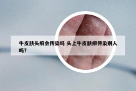 牛皮膚頭癬會傳染嗎 頭上牛皮膚癬傳染別人嗎?