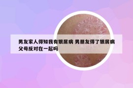 男友家人得知我有銀屑病 男朋友得了銀屑病父母反對(duì)在一起嗎