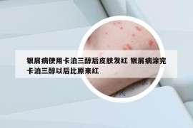 銀屑病使用卡泊三醇后皮膚發(fā)紅 銀屑病涂完卡泊三醇以后比原來紅