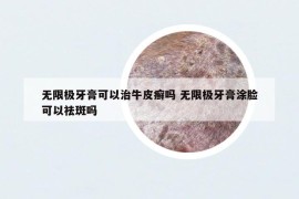 無限極牙膏可以治牛皮癬嗎 無限極牙膏涂臉可以祛斑嗎