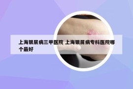 上海銀屑病三甲醫(yī)院 上海銀屑病?？漆t(yī)院哪個(gè)最好