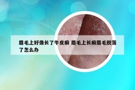眉毛上好像長了牛皮癬 眉毛上長癬眉毛脫落了怎么辦