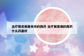 治療銀皮癬最有效的西藥 治療銀屑病的西藥什么藥最好
