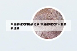 銀屑病研究的最新進(jìn)展 銀屑病研究有沒有最新進(jìn)展