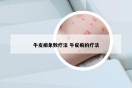 牛皮癬象數(shù)療法 牛皮癬的療法