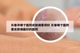長春市哪個醫(yī)院皮膚病看得好 長春哪個醫(yī)院看皮膚病最好的醫(yī)院