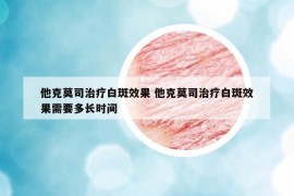 他克莫司治療白斑效果 他克莫司治療白斑效果需要多長時間
