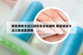 銀屑病用卡泊三醇軟膏會(huì)反彈嗎 銀屑病涂卡泊三醇涂染很癢