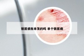 銀屑病有單發(fā)的嗎 單個(gè)銀屑病