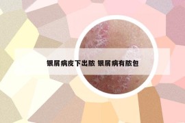 銀屑病皮下出膿 銀屑病有膿包