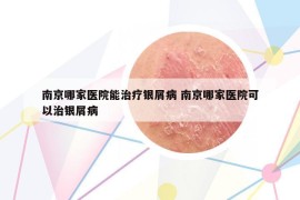 南京哪家醫(yī)院能治療銀屑病 南京哪家醫(yī)院可以治銀屑病