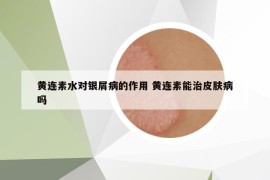 黃連素水對(duì)銀屑病的作用 黃連素能治皮膚病嗎